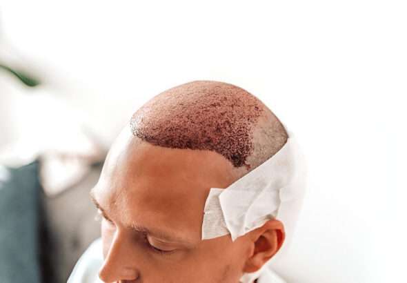 Hair Transplant