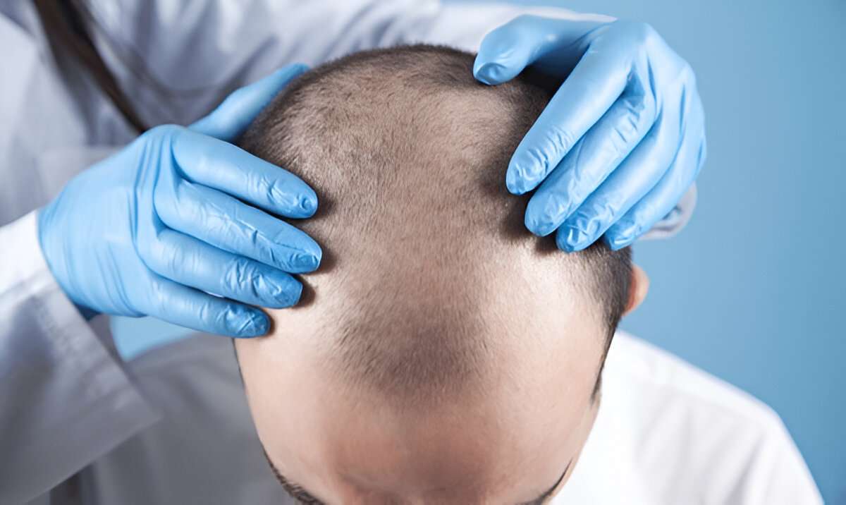 hair transplant cost London