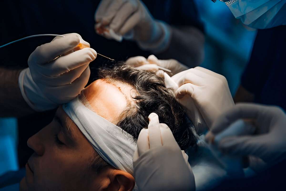 hair transplant Manchester